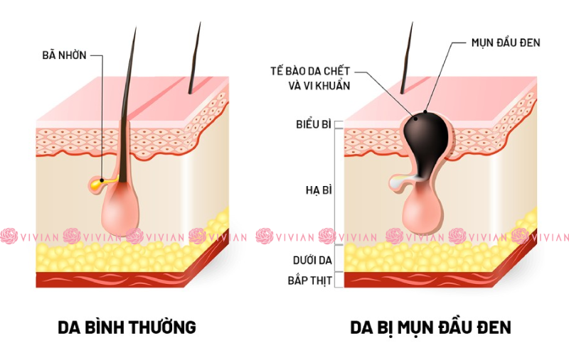 cách trị mụn đầu đen tại nhà
