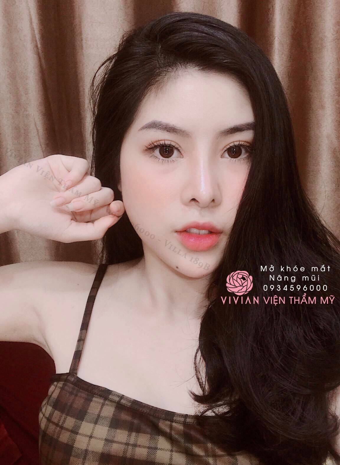 mở góc mắt tại vivian