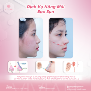 mũi bọc sụn vivian