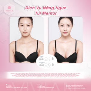 nâng ngực túi Mentor vivan