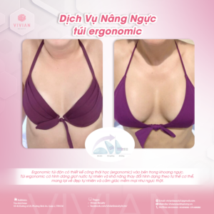 nâng ngực túi ergonomic vivian