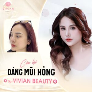 Khách hàng sau khi nâng mũi tại Vivian