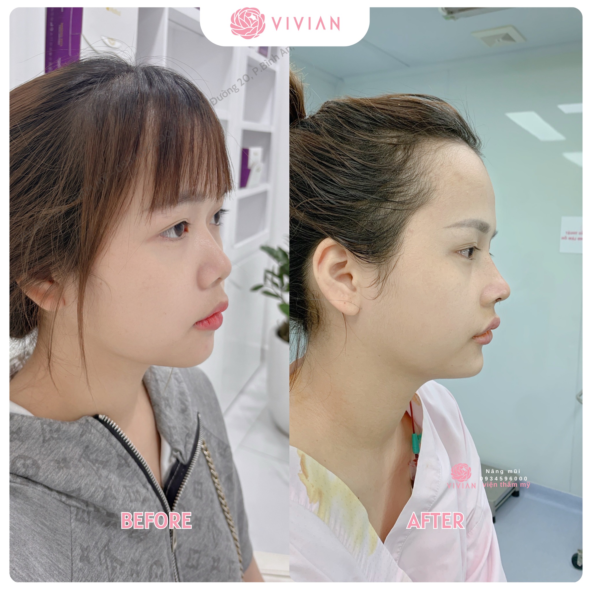 khách hàng nâng mũi tại vivian 34