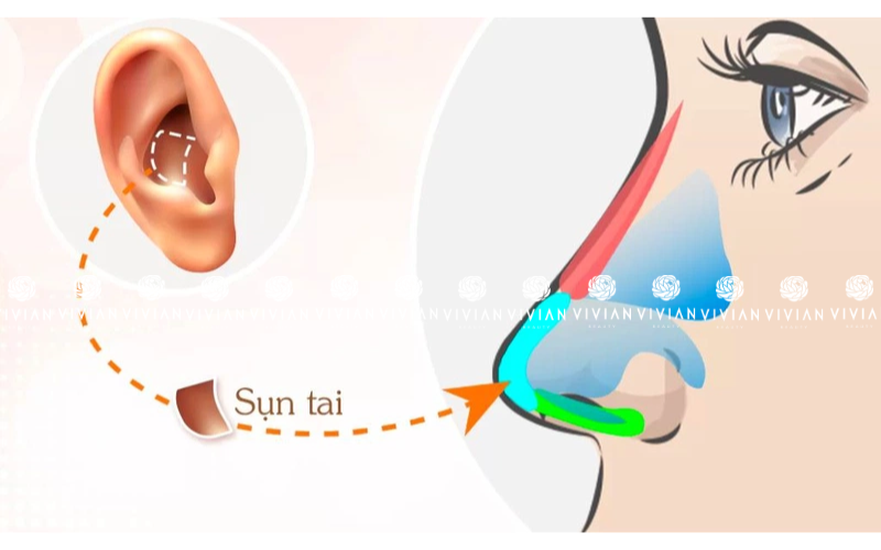 nâng mũi bọc sụn tai