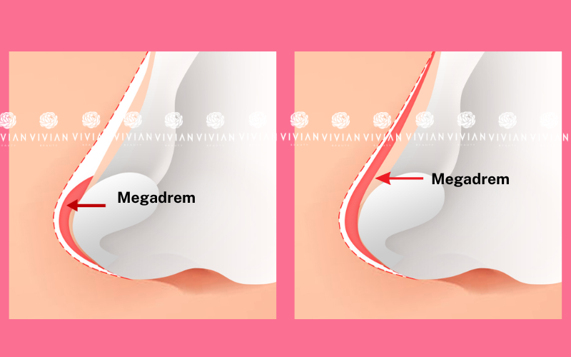 nâng mũi bọc sụn megaderm